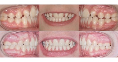 agenesie-dentarie 1.jpg